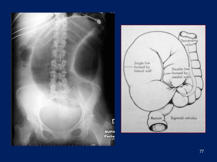 ogilvie syndrome