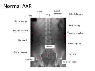 Normal AXR
11th rib
Hepatic flexure
Gas in
stomach
T12
Gas in caecum
Iliac crest
Femoral head
SI joint
Gas in sigmoid
Transverse colon
Splenic flexure
Psoas margin
Sacrum
Left kidney
Liver
Bladder
 