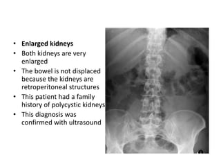 • Enlarged kidneys
• Both kidneys are very
enlarged
• The bowel is not displaced
because the kidneys are
retroperitoneal structures
• This patient had a family
history of polycystic kidneys
• This diagnosis was
confirmed with ultrasound
 