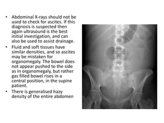 • Abdominal X-rays should not be
used to check for ascites. If this
diagnosis is suspected then
again ultrasound is the best
initial investigation, and can
also be used to assist drainage.
• Fluid and soft tissues have
similar densities, and so ascites
may be mistaken for
organomegaly. The bowel does
not appear pushed to the side
as in organomegaly, but rather
gas filled bowel rises in a
central position, in the supine
patient.
• There is generalised hazy
density of the entire abdomen
 