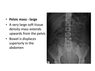 • Pelvic mass - large
• A very large soft tissue
density mass extends
upwards from the pelvis
• Bowel is displaces
superiorly in the
abdomen
 