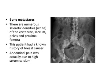 • Bone metastases
• There are numerous
sclerotic densities (white)
of the vertebrae, sacrum,
pelvis and proximal
femora
• This patient had a known
history of breast cancer
• Abdominal pain was
actually due to high
serum calcium
 