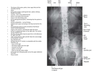 • The bones of the spine, pelvis, chest cage (ribs) and the
sacroiliac and hip
• joints
• ● The dark margins outlining the liver, spleen, kidneys,
bladder and psoas
• muscles – this is intra-abdominal fat
• ● Gas in the body of the stomach
• ● Gas in the descending colon
• ● The wide gynaecoid pelvis, indicating that the patient is
female
• ● Pelvic phleboliths – normal finding
• ● Minor joint space narrowing in the hips (normal for this
age)
• ● The granular texture of the amorphous fluid faecal
matter containing pockets
• of gas in the caecum, overlying the right iliac bone
• ● The ‘R’ marked low down on the right side. The marker
can be anywhere on
• the film and you often have to search for it. All references
to ‘right’ and ‘left’
• refer to the patient’s right and left. Note the name badge
at the bottom, not the
• top, (blacked out)
• ● Check that the ‘R’ marker is compatible with the visible
anatomy, e.g.
• – liver on the right
• – left kidney higher than the right
• – stomach on the left
• – spleen on the left
• – heart on the left, when visible
• ● The dark skin fold going right across the upper abdomen
(normal).
• Psoas muscle
 