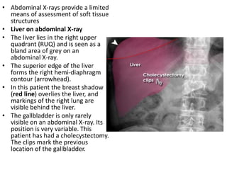 • Abdominal X-rays provide a limited
means of assessment of soft tissue
structures
• Liver on abdominal X-ray
• The liver lies in the right upper
quadrant (RUQ) and is seen as a
bland area of grey on an
abdominal X-ray.
• The superior edge of the liver
forms the right hemi-diaphragm
contour (arrowhead).
• In this patient the breast shadow
(red line) overlies the liver, and
markings of the right lung are
visible behind the liver.
• The gallbladder is only rarely
visible on an abdominal X-ray. Its
position is very variable. This
patient has had a cholecystectomy.
The clips mark the previous
location of the gallbladder.
 