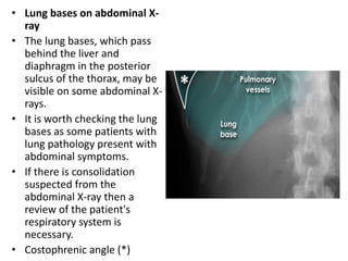 • Lung bases on abdominal X-
ray
• The lung bases, which pass
behind the liver and
diaphragm in the posterior
sulcus of the thorax, may be
visible on some abdominal X-
rays.
• It is worth checking the lung
bases as some patients with
lung pathology present with
abdominal symptoms.
• If there is consolidation
suspected from the
abdominal X-ray then a
review of the patient's
respiratory system is
necessary.
• Costophrenic angle (*)
 