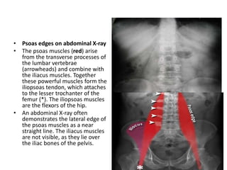 • Psoas edges on abdominal X-ray
• The psoas muscles (red) arise
from the transverse processes of
the lumbar vertebrae
(arrowheads) and combine with
the iliacus muscles. Together
these powerful muscles form the
iliopsoas tendon, which attaches
to the lesser trochanter of the
femur (*). The iliopsoas muscles
are the flexors of the hip.
• An abdominal X-ray often
demonstrates the lateral edge of
the psoas muscles as a near
straight line. The iliacus muscles
are not visible, as they lie over
the iliac bones of the pelvis.
 