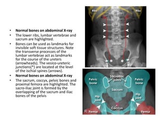 • Normal bones on abdominal X-ray
• The lower ribs, lumbar vertebrae and
sacrum are highlighted.
• Bones can be used as landmarks for
invisible soft tissue structures. Note
the transverse processes of the
lumbar vertebrae act as landmarks
for the course of the ureters
(arrowheads). The vesico-ureteric
junctions(*) are located at the level
of the ischial spines (arrows).
• Normal bones on abdominal X-ray
• The sacrum, coccyx, pelvic bones and
proximal femora are highlighted. The
sacro-iliac joint is formed by the
overlapping of the sacrum and iliac
bones of the pelvis
 