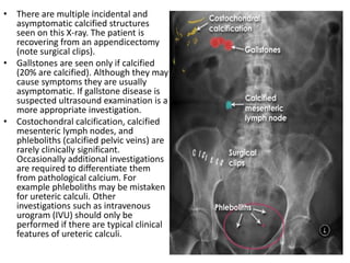 • There are multiple incidental and
asymptomatic calcified structures
seen on this X-ray. The patient is
recovering from an appendicectomy
(note surgical clips).
• Gallstones are seen only if calcified
(20% are calcified). Although they may
cause symptoms they are usually
asymptomatic. If gallstone disease is
suspected ultrasound examination is a
more appropriate investigation.
• Costochondral calcification, calcified
mesenteric lymph nodes, and
phleboliths (calcified pelvic veins) are
rarely clinically significant.
Occasionally additional investigations
are required to differentiate them
from pathological calcium. For
example phleboliths may be mistaken
for ureteric calculi. Other
investigations such as intravenous
urogram (IVU) should only be
performed if there are typical clinical
features of ureteric calculi.
 