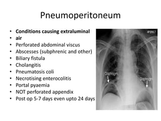Pneumoperitoneum
• Conditions causing extraluminal
• air
• Perforated abdominal viscus
• Abscesses (subphrenic and other)
• Biliary fistula
• Cholangitis
• Pneumatosis coli
• Necrotising enterocolitis
• Portal pyaemia
• NOT perforated appendix
• Post op 5-7 days even upto 24 days
 