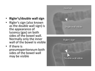• Rigler's/double wall sign
• Rigler's sign (also known
as the double wall sign) is
the appearance of
lucency (gas) on both
sides of the bowel wall.
Normally only the inner
wall of the bowel is visible
• If there is
pneumoperitoneum both
sides of the bowel wall
may be visible
 