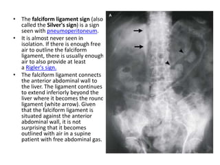 • The falciform ligament sign (also
called the Silver's sign) is a sign
seen with pneumoperitoneum.
• It is almost never seen in
isolation. If there is enough free
air to outline the falciform
ligament, there is usually enough
air to also provide at least
a Rigler's sign.
• The falciform ligament connects
the anterior abdominal wall to
the liver. The ligament continues
to extend inferiorly beyond the
liver where it becomes the round
ligament (white arrow). Given
that the falciform ligament is
situated against the anterior
abdominal wall, it is not
surprising that it becomes
outlined with air in a supine
patient with free abdominal gas.
 
