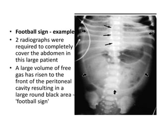 • Football sign - example
• 2 radiographs were
required to completely
cover the abdomen in
this large patient
• A large volume of free
gas has risen to the
front of the peritoneal
cavity resulting in a
large round black area -
'football sign'
 