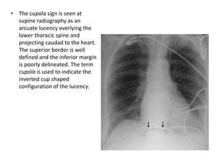 • The cupola sign is seen at
supine radiography as an
arcuate lucency overlying the
lower thoracic spine and
projecting caudad to the heart.
The superior border is well
defined and the inferior margin
is poorly delineated. The term
cupola is used to indicate the
inverted cup shaped
configuration of the lucency.
 