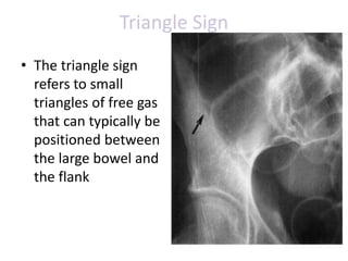 Triangle Sign
• The triangle sign
refers to small
triangles of free gas
that can typically be
positioned between
the large bowel and
the flank
 