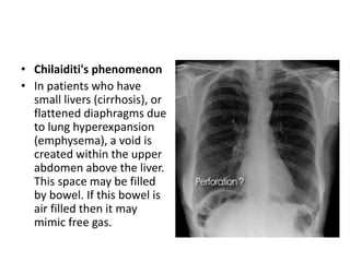 • Chilaiditi's phenomenon
• In patients who have
small livers (cirrhosis), or
flattened diaphragms due
to lung hyperexpansion
(emphysema), a void is
created within the upper
abdomen above the liver.
This space may be filled
by bowel. If this bowel is
air filled then it may
mimic free gas.
 