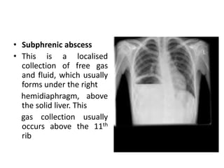 • Subphrenic abscess
• This is a localised
collection of free gas
and fluid, which usually
forms under the right
hemidiaphragm, above
the solid liver. This
gas collection usually
occurs above the 11th
rib
 