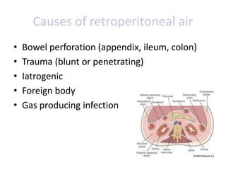 Causes of retroperitoneal air
• Bowel perforation (appendix, ileum, colon)
• Trauma (blunt or penetrating)
• Iatrogenic
• Foreign body
• Gas producing infection
 