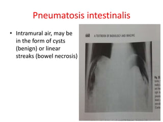 Pneumatosis intestinalis
• Intramural air, may be
in the form of cysts
(benign) or linear
streaks (bowel necrosis)
 