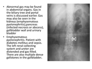 • Abnormal gas may be found
in abdominal organs. Gas in
the biliary tree and portal
veins is discussed earlier. Gas
may also be seen in the
kidneys (emphysematous
pyelonephritis),pancreas
(infected necrosis or abscess),
gallbladder wall and urinary
bladder
• Emphysematous
pyelonephritis. Patient with
diabetes mellitus and sepsis.
The left renal collecting
system and ureter are
distended and gas filled.
There are also multiple dense
gallstones in the gallbladder.
 