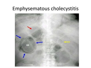 Emphysematous cholecystitis
 