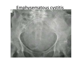 Emphysematous cystitis
 