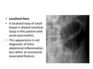 • Localised Ileus
• A localized loop of small
bowel is dilated (sentinal
loop) in this patient with
acute pancreatitis.
• This appearance is not
diagnostic of intra-
abdominal inflammation,
but rather an occasional
associated feature.
 