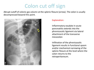 Colon cut off sign
Explanation:
Inflammatory exudate in acute
pancreatitis extends into the
phrenicocolic ligament via lateral
attachment of the transverse
mesocolon
Infiltration of the phrenicocolic
ligament results in functional spasm
and/or mechanical narrowing of the
splenic flexure at the level where the
colon returns to the
retroperitoneum.
Abrupt cutoff of colonic gas column at the splenic flexure (arrow). The colon is usually
decompressed beyond this point.
 