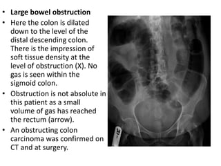• Large bowel obstruction
• Here the colon is dilated
down to the level of the
distal descending colon.
There is the impression of
soft tissue density at the
level of obstruction (X). No
gas is seen within the
sigmoid colon.
• Obstruction is not absolute in
this patient as a small
volume of gas has reached
the rectum (arrow).
• An obstructing colon
carcinoma was confirmed on
CT and at surgery.
 