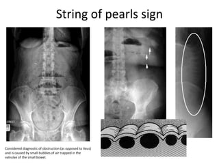 String of pearls sign
Considered diagnostic of obstruction (as opposed to ileus)
and is caused by small bubbles of air trapped in the
valvulae of the small bowel.
 