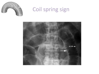 Coil spring sign
 