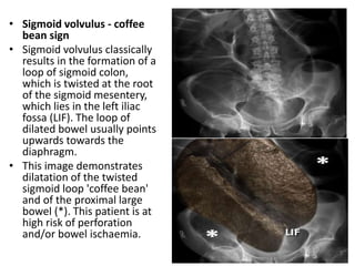 • Sigmoid volvulus - coffee
bean sign
• Sigmoid volvulus classically
results in the formation of a
loop of sigmoid colon,
which is twisted at the root
of the sigmoid mesentery,
which lies in the left iliac
fossa (LIF). The loop of
dilated bowel usually points
upwards towards the
diaphragm.
• This image demonstrates
dilatation of the twisted
sigmoid loop 'coffee bean'
and of the proximal large
bowel (*). This patient is at
high risk of perforation
and/or bowel ischaemia.
 