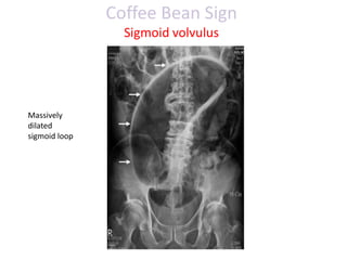 Coffee Bean Sign
Sigmoid volvulus
Massively
dilated
sigmoid loop
 