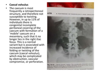 • Caecal volvulus
• The caecum is most
frequently a retroperitoneal
structure, and therefore not
susceptible to twisting.
However, in up to 11% of
individuals there is
congenital incomplete
peritoneal covering of the
caecum with formation of a
'mobile' caecum on a
mesentery, such that it no
longer lies in the right iliac
fossa. This is a normal
variant but is associated with
increased incidence of
folding or twisting of the
caecum (caecal volvulus),
which may be complicated
by obstruction, vascular
compromise, or perforation.
 