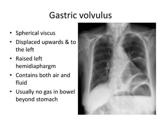 Gastric volvulus
• Spherical viscus
• Displaced upwards & to
the left
• Raised left
hemidiaphargm
• Contains both air and
fluid
• Usually no gas in bowel
beyond stomach
 