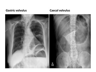 Gastric volvulus Caecal volvulus
 