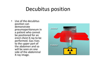 Decubitus position
• Use of the decubitus
position can
demonstrate
pneumoperitoneum in
a patient who cannot
be positioned for an
erect chest X-ray to be
performed. Gas rises
to the upper part of
the abdomen and so
will be seen on one
side of the abdominal
X-ray image.
 