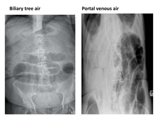 Biliary tree air Portal venous air
 