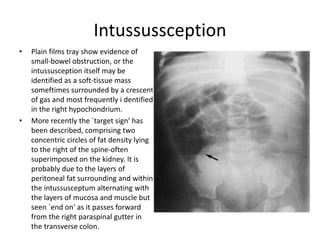Intussussception
• Plain films tray show evidence of
small-bowel obstruction, or the
intussusception itself may be
identified as a soft-tissue mass
someftimes surrounded by a crescent
of gas and most frequently i dentified
in the right hypochondrium.
• More recently the `target sign' has
been described, comprising two
concentric circles of fat density lying
to the right of the spine-often
superimposed on the kidney. It is
probably due to the layers of
peritoneal fat surrounding and within
the intussusceptum alternating with
the layers of mucosa and muscle but
seen `end on' as it passes forward
from the right paraspinal gutter in
the transverse colon.
 