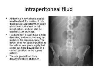 Intraperitoneal fliud
• Abdominal X-rays should not be
used to check for ascites. If this
diagnosis is suspected then again
ultrasound is the best initial
investigation, and can also be
used to assist drainage.
• Fluid and soft tissues have similar
densities, and so ascites may be
mistaken for organomegaly. The
bowel does not appear pushed to
the side as in organomegaly, but
rather gas filled bowel rises in a
central position, in the supine
patient.
• There is generalized hazy
densityof entiree abdomen
 