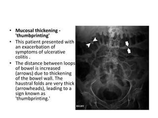 • Mucosal thickening -
'thumbprinting'
• This patient presented with
an exacerbation of
symptoms of ulcerative
colitis .
• The distance between loops
of bowel is increased
(arrows) due to thickening
of the bowel wall. The
haustral folds are very thick
(arrowheads), leading to a
sign known as
'thumbprinting.'
 