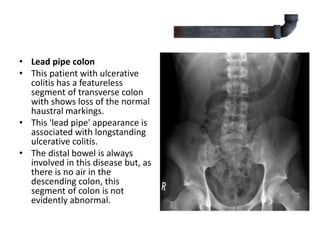 • Lead pipe colon
• This patient with ulcerative
colitis has a featureless
segment of transverse colon
with shows loss of the normal
haustral markings.
• This 'lead pipe' appearance is
associated with longstanding
ulcerative colitis.
• The distal bowel is always
involved in this disease but, as
there is no air in the
descending colon, this
segment of colon is not
evidently abnormal.
 
