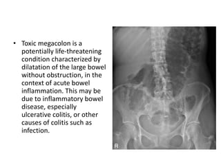 • Toxic megacolon is a
potentially life-threatening
condition characterized by
dilatation of the large bowel
without obstruction, in the
context of acute bowel
inflammation. This may be
due to inflammatory bowel
disease, especially
ulcerative colitis, or other
causes of colitis such as
infection.
 