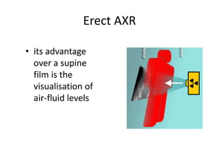 Erect AXR
• its advantage
over a supine
film is the
visualisation of
air-fluid levels
 