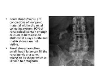 • Renal stones/calculi are
concretions of inorganic
material within the renal
collecting system. 90% of
renal calculi contain enough
calcium to be visible on
abdominal X-rays. Urate and
matrix stones are not
visible.
• Renal stones are often
small, but if large can fill the
renal pelvis or a calyx,
taking on its shape which is
likened to a staghorn.
 