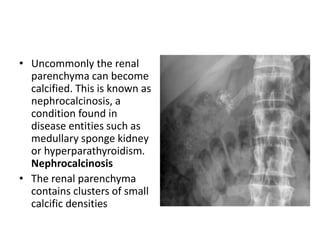 • Uncommonly the renal
parenchyma can become
calcified. This is known as
nephrocalcinosis, a
condition found in
disease entities such as
medullary sponge kidney
or hyperparathyroidism.
Nephrocalcinosis
• The renal parenchyma
contains clusters of small
calcific densities
 