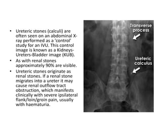 • Ureteric stones (calculi) are
often seen on an abdominal X-
ray performed as a 'control'
study for an IVU. This control
image is known as a Kidneys-
Ureters-Bladder image (KUB).
• As with renal stones
approximately 90% are visible.
• Ureteric stones originate as
renal stones. If a renal stone
migrates into a ureter it may
cause renal outflow tract
obstruction, which manifests
clinically with severe ipsilateral
flank/loin/groin pain, usually
with haematuria.
 