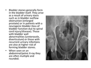 • Bladder stones generally form
in the bladder itself. They arise
as a result of urinary stasis
such as in bladder outflow
obstruction (enlarged
prostate) or in patients with a
neurogenic bladder (loss of
bladder function due to spinal
cord injury/disease). Those
with bladder wall
abnormalities (ureterocele,
diverticulum) or those with
recurrent urinary infections
are also at higher risk of
forming bladder stones.
• When seen on an
abdominal/pelvic X-ray they
are often multiple and
rounded.
 