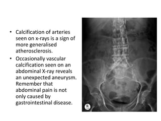 • Calcification of arteries
seen on x-rays is a sign of
more generalised
atherosclerosis.
• Occasionally vascular
calcification seen on an
abdominal X-ray reveals
an unexpected aneurysm.
Remember that
abdominal pain is not
only caused by
gastrointestinal disease.
 