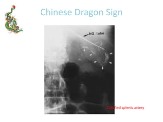 Chinese Dragon Sign
Calcified splenic artery
 