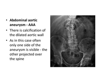 • Abdominal aortic
aneurysm - AAA
• There is calcification of
the dilated aortic wall
• As in this case often
only one side of the
aneurysm is visible - the
other projected over
the spine
 